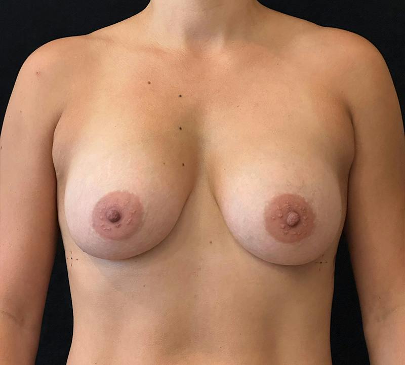 Breast Augmentation Subfascial Before & After Gallery - Patient 909938 - Image 2