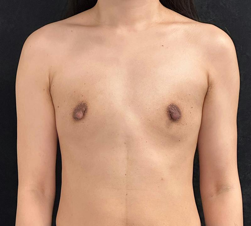 Breast Augmentation Subfascial Before & After Gallery - Patient 165841 - Image 1