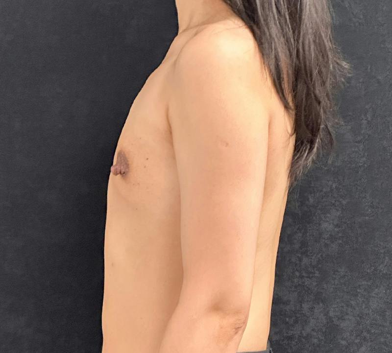 Breast Augmentation Subfascial Before & After Gallery - Patient 165841 - Image 9