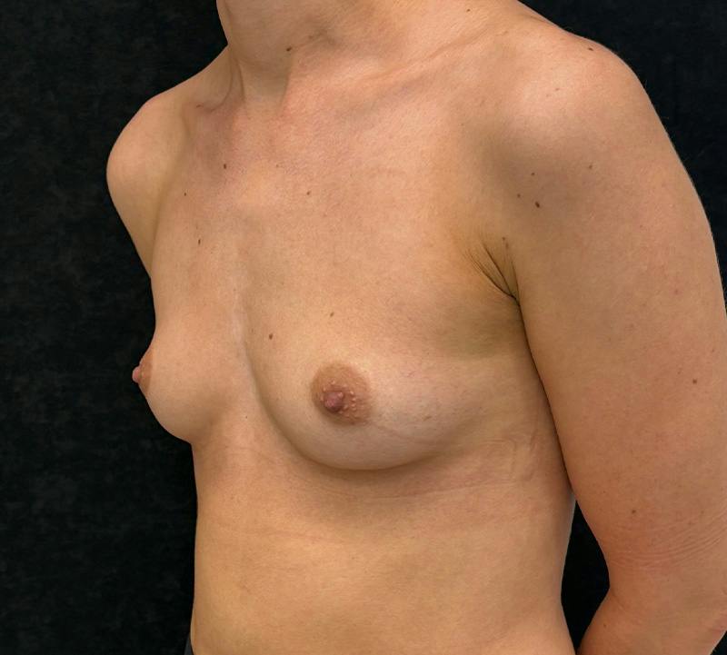 Breast Augmentation Subfascial Before & After Gallery - Patient 343692 - Image 7