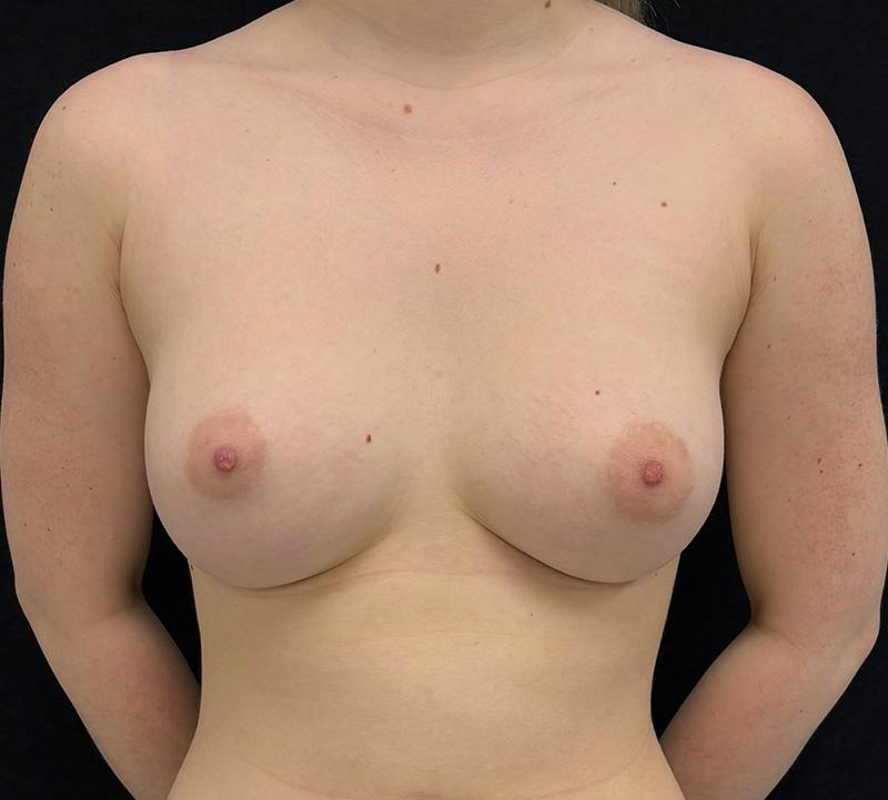 Breast Augmentation Subfascial Before & After Gallery - Patient 490050 - Image 2