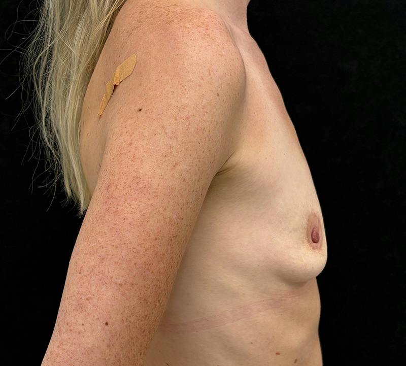 Breast Augmentation Subfascial Before & After Gallery - Patient 305219 - Image 5