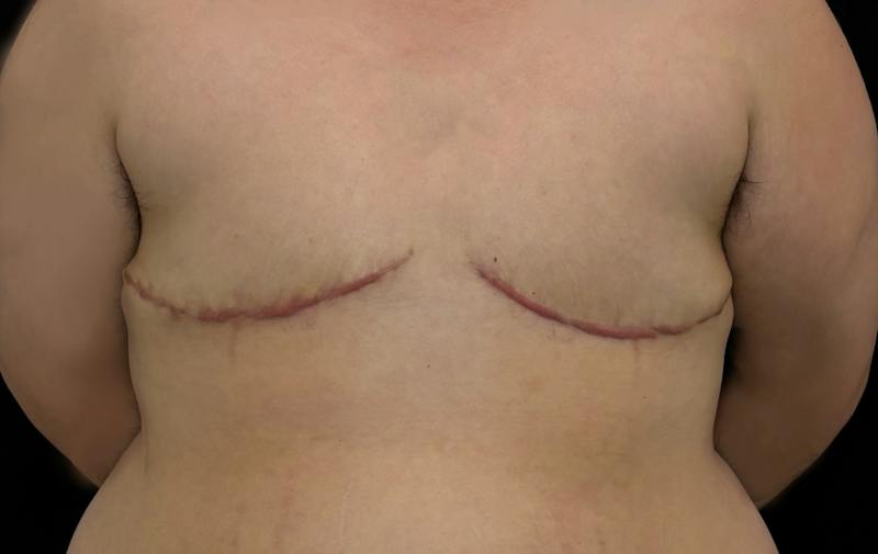Transgender Top Surgery Before & After Gallery - Patient 373509 - Image 2