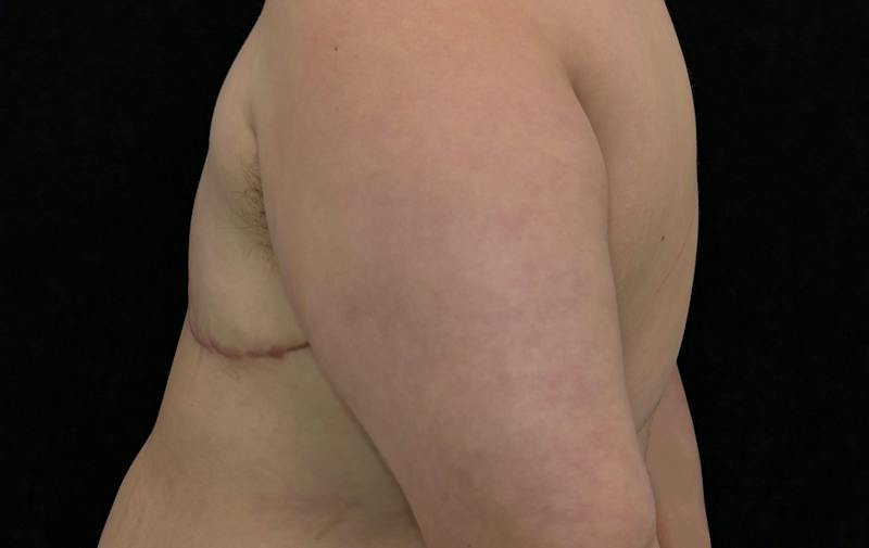 Transgender Top Surgery Before & After Gallery - Patient 373509 - Image 10
