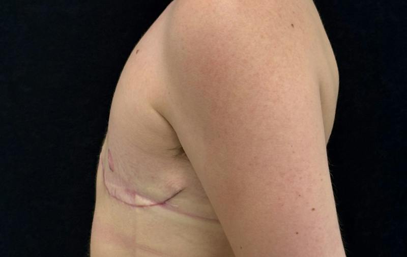 Transgender Top Surgery Before & After Gallery - Patient 321122 - Image 10