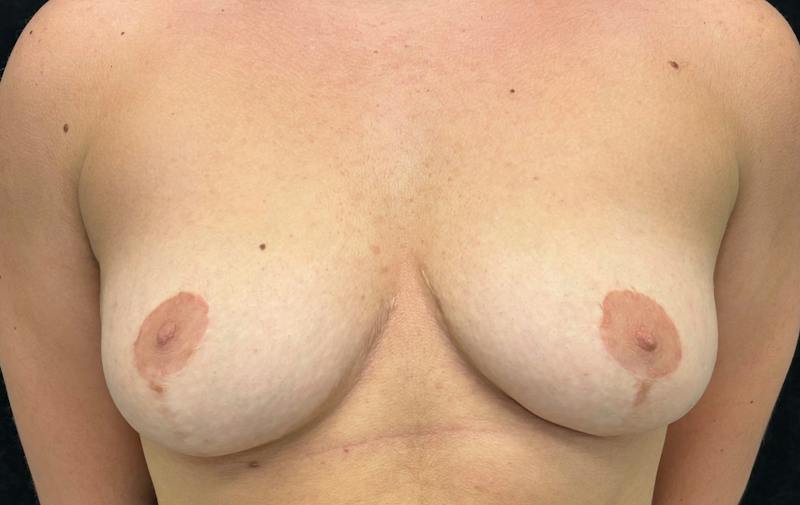 Transgender Top Surgery Before & After Gallery - Patient 321122 - Image 1