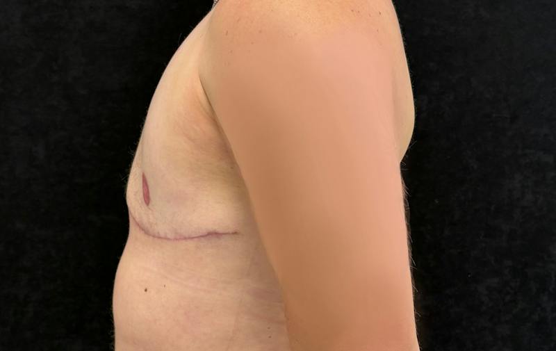 Transgender Top Surgery Before & After Gallery - Patient 250647 - Image 10