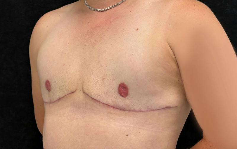 Transgender Top Surgery Before & After Gallery - Patient 250647 - Image 8
