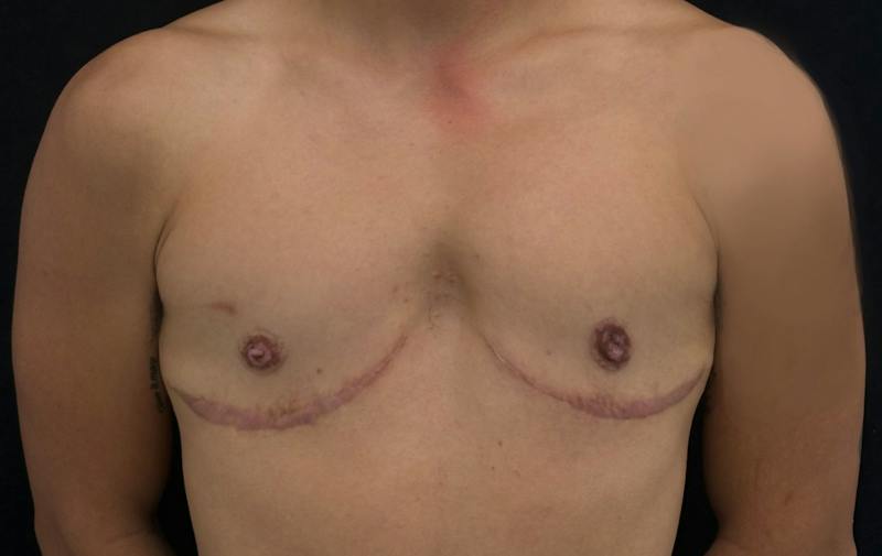 Transgender Top Surgery Before & After Gallery - Patient 418946 - Image 2