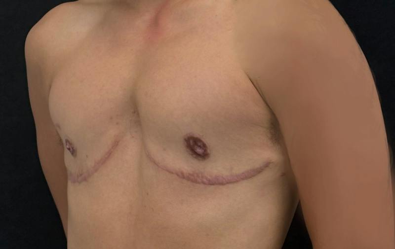 Transgender Top Surgery Before & After Gallery - Patient 418946 - Image 8