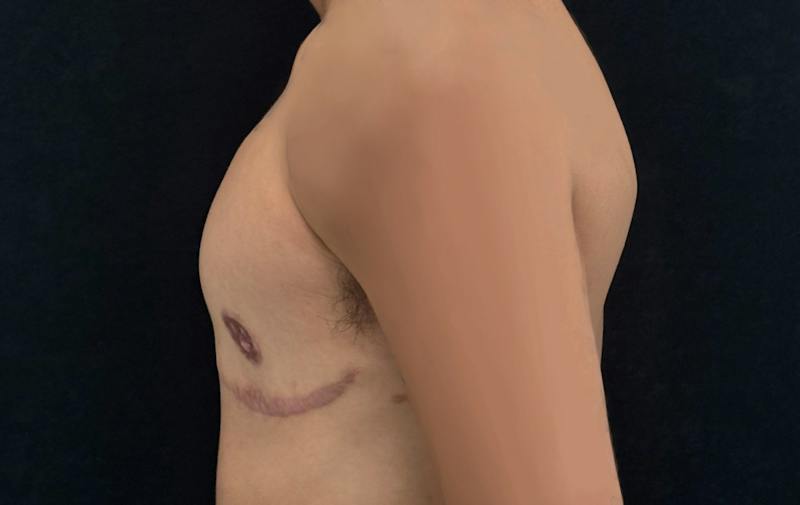 Transgender Top Surgery Before & After Gallery - Patient 418946 - Image 10
