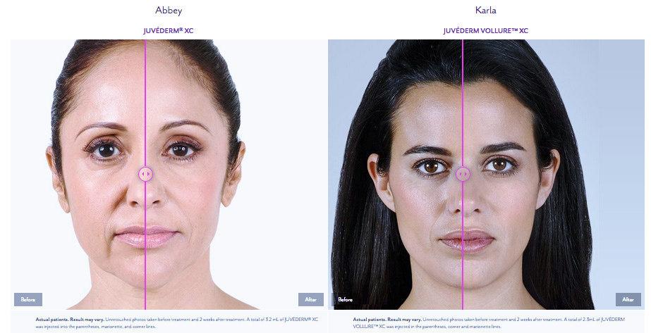 Juvederm before and after photos