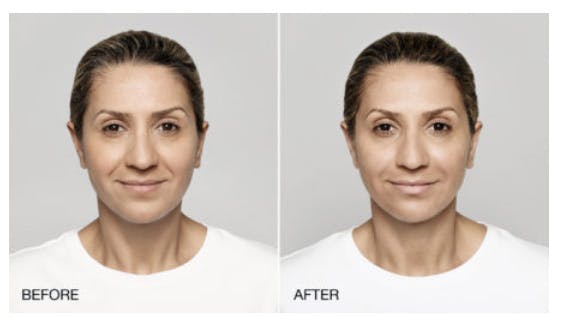 Restylane Lyft