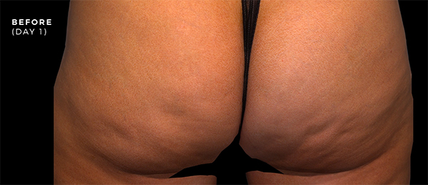 QWO-Cellulite Treatment