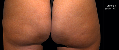 QWO-Cellulite Treatment