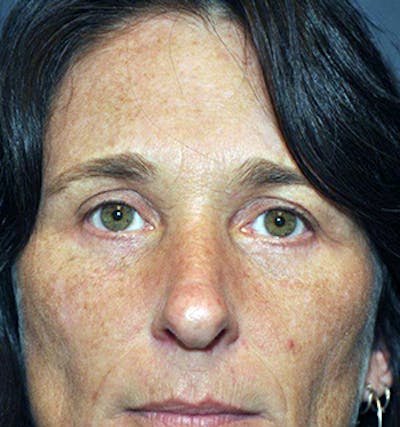 Blepharoplasty Before & After Gallery - Patient 122053954 - Image 2