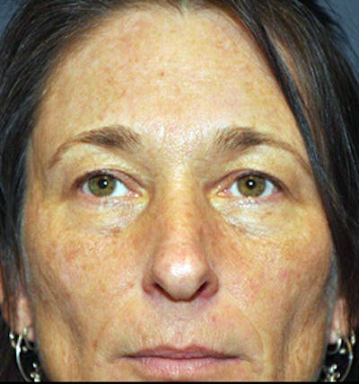 Blepharoplasty Before & After Gallery - Patient 122053954 - Image 1