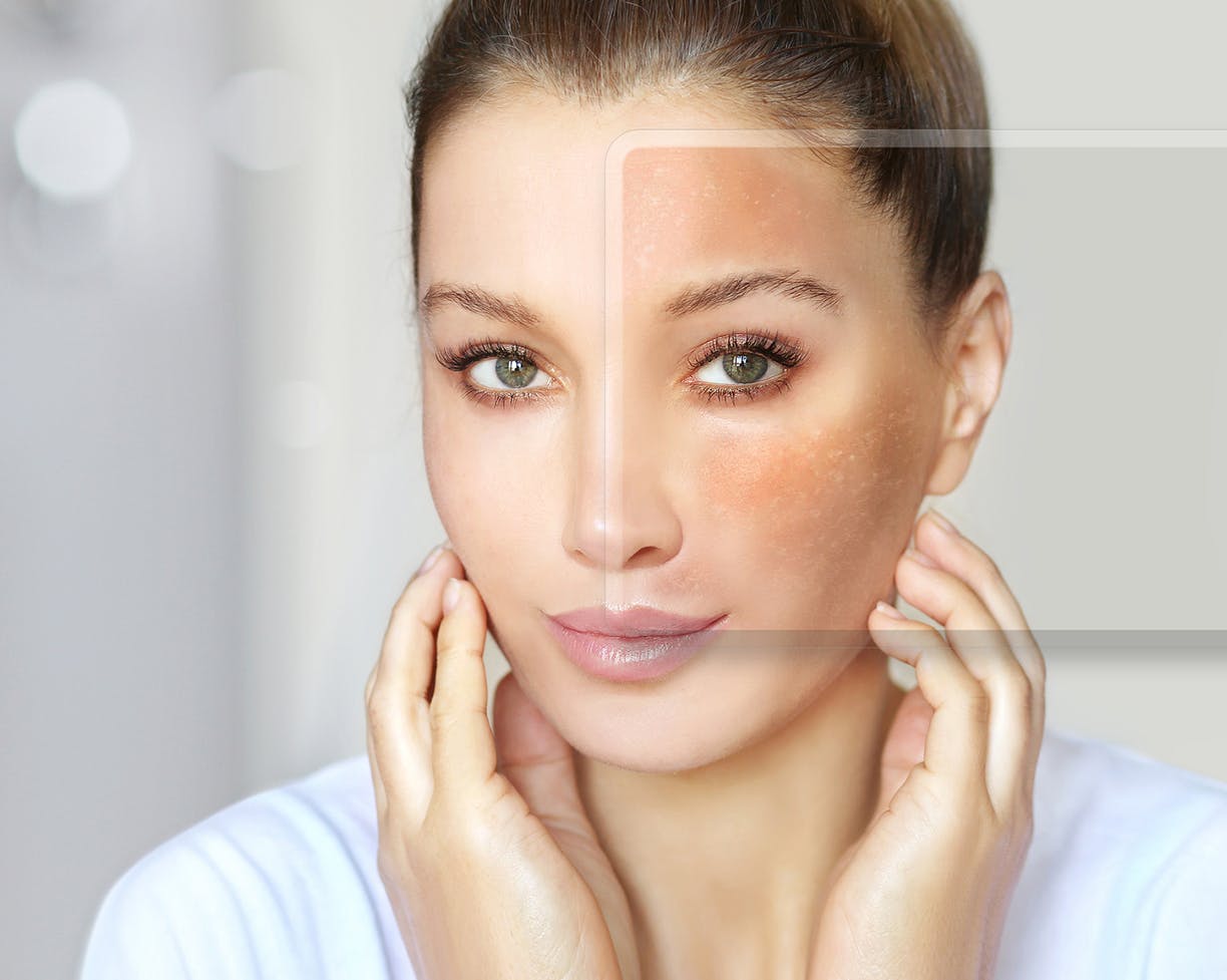 Woman touching her face that has red patches
