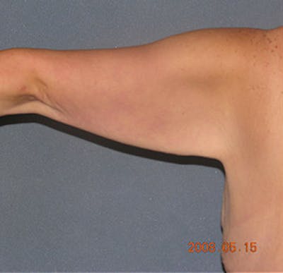 Brachioplasty Before & After Gallery - Patient 122054330 - Image 1