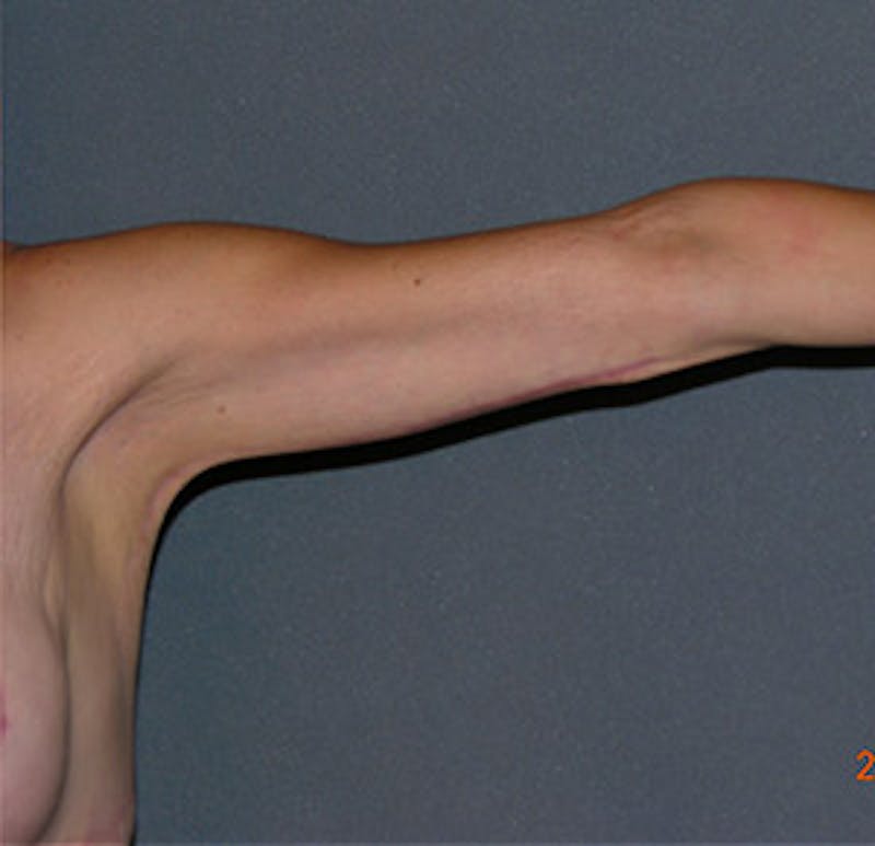 Brachioplasty Before & After Gallery - Patient 122054330 - Image 4