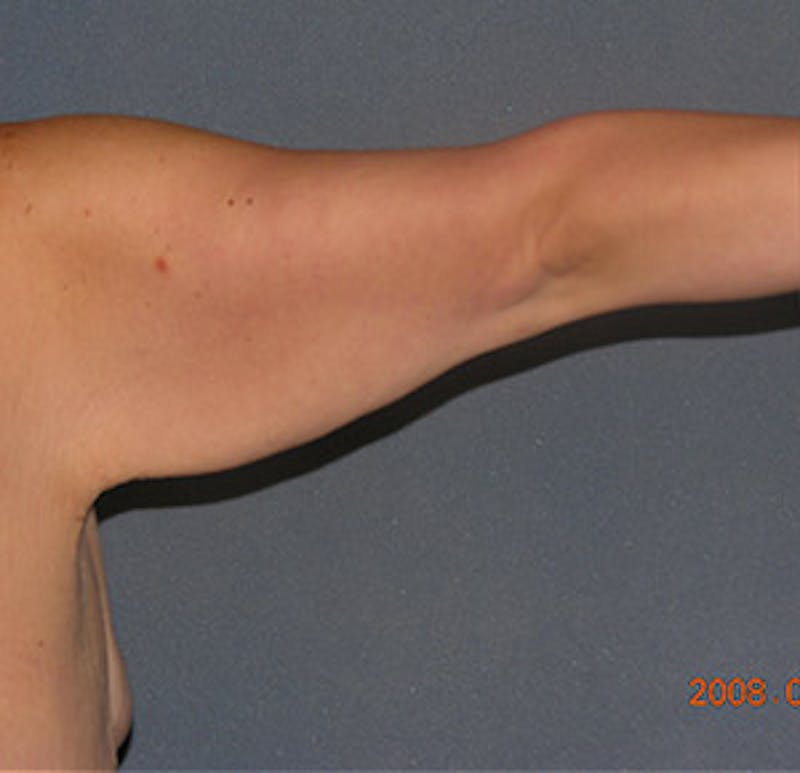 Brachioplasty Before & After Gallery - Patient 122054330 - Image 3