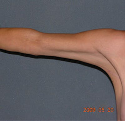 Brachioplasty Before & After Gallery - Patient 122054330 - Image 2