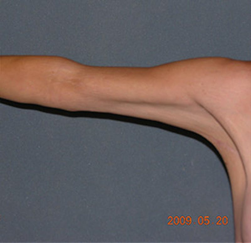 Brachioplasty Before & After Gallery - Patient 122054330 - Image 2