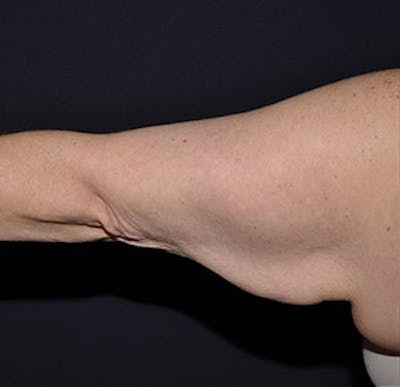 Brachioplasty Before & After Gallery - Patient 122054331 - Image 1