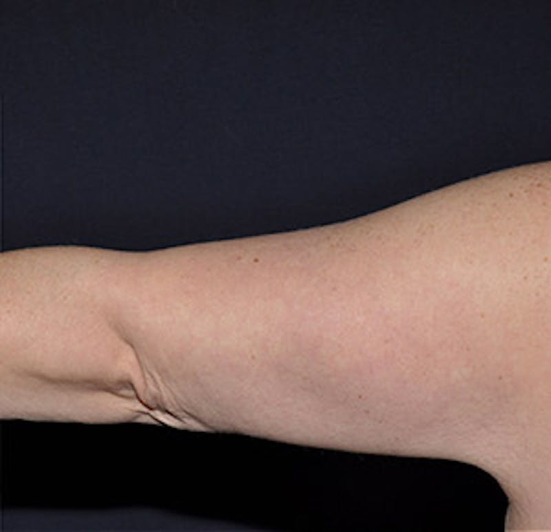 Brachioplasty Before & After Gallery - Patient 122054331 - Image 2