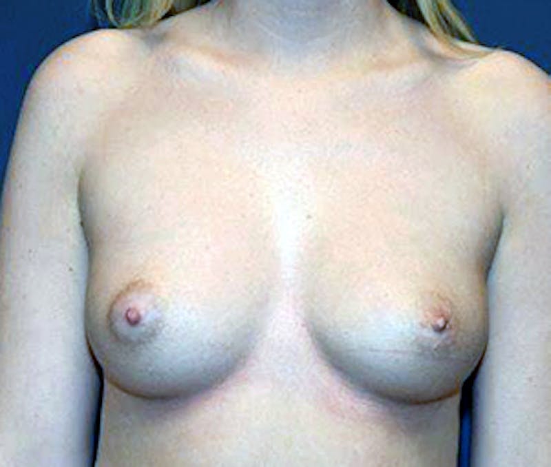 Breast Augmentation Before & After Gallery - Patient 122054462 - Image 1