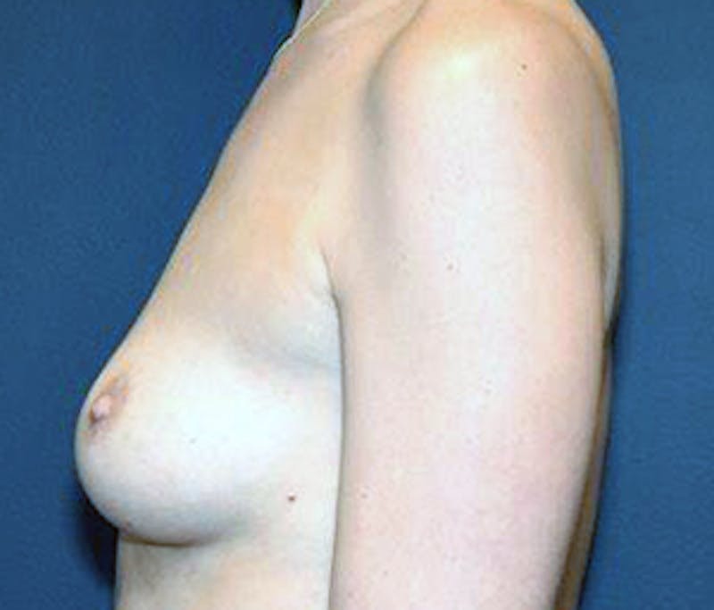 Breast Augmentation Before & After Gallery - Patient 122054463 - Image 3