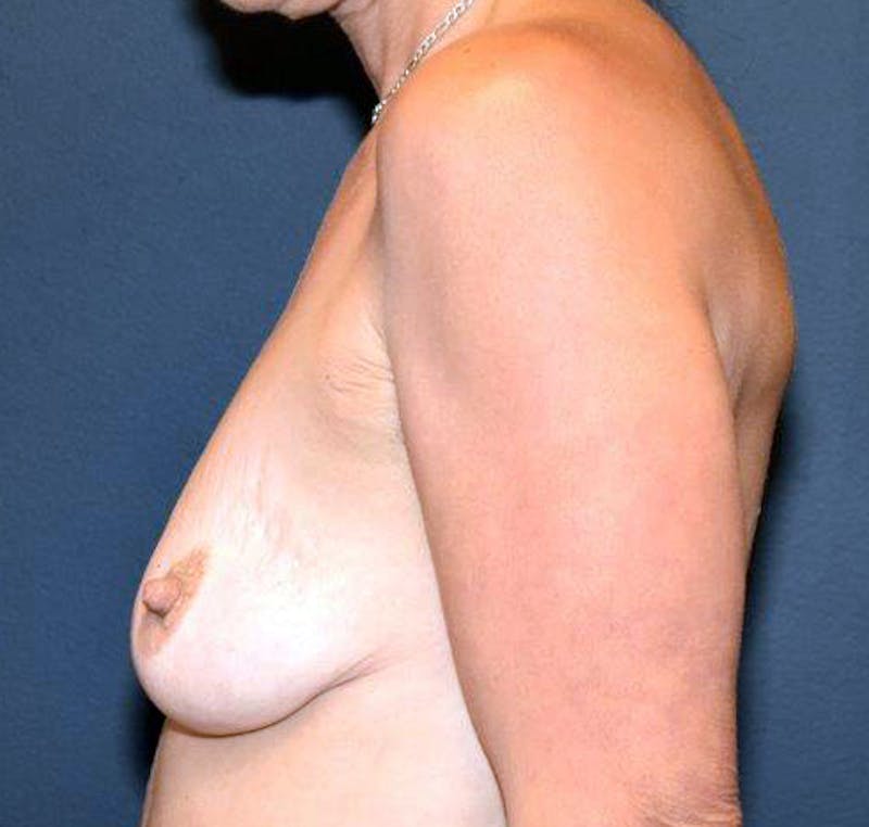 Breast Augmentation Before & After Gallery - Patient 122054465 - Image 3