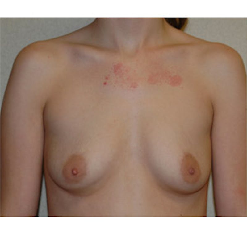 Breast Augmentation Before & After Gallery - Patient 122054467 - Image 1