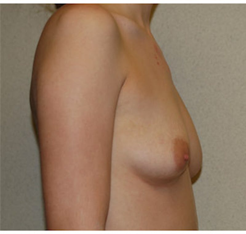 Breast Augmentation Before & After Gallery - Patient 122054467 - Image 3