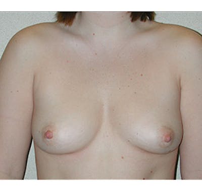 Breast Augmentation Before & After Gallery - Patient 122054468 - Image 1