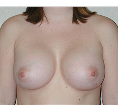 Breast Augmentation Before & After Gallery - Patient 122054468 - Image 2