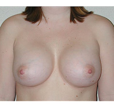 Breast Augmentation Gallery - Patient 122054468 - Image 2