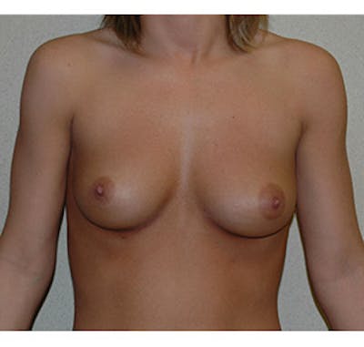 Breast Augmentation Before & After Gallery - Patient 122054469 - Image 1