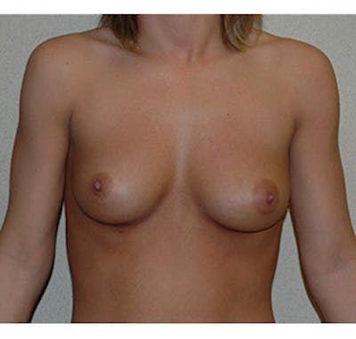 Breast Augmentation Before & After Gallery - Patient 122054469 - Image 1