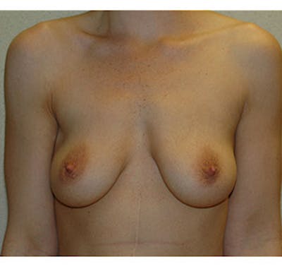 Breast Augmentation Before & After Gallery - Patient 122054470 - Image 1