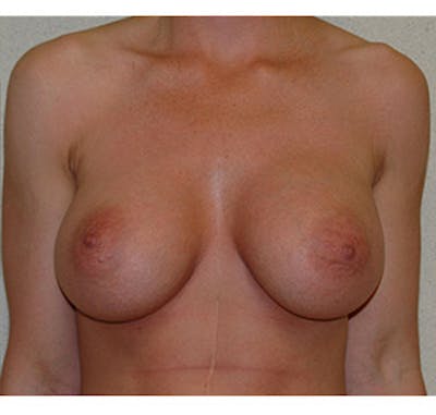 Breast Augmentation Before & After Gallery - Patient 122054470 - Image 2