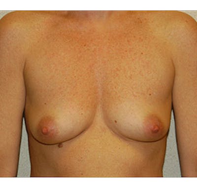 Breast Augmentation Before & After Gallery - Patient 122054472 - Image 1