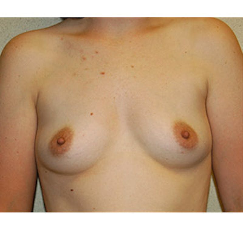 Breast Augmentation Before & After Gallery - Patient 122054473 - Image 1