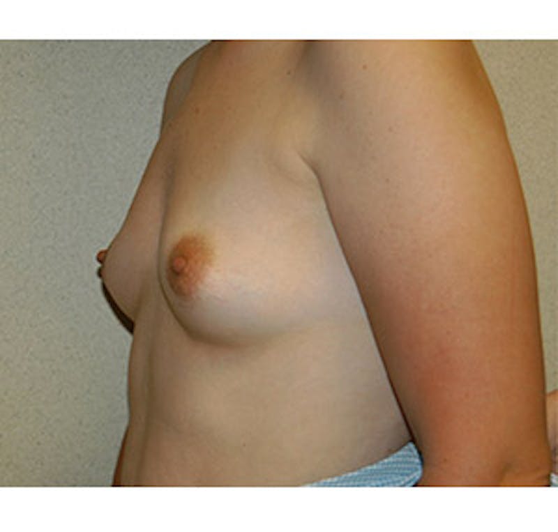 Breast Augmentation Before & After Gallery - Patient 122054473 - Image 5