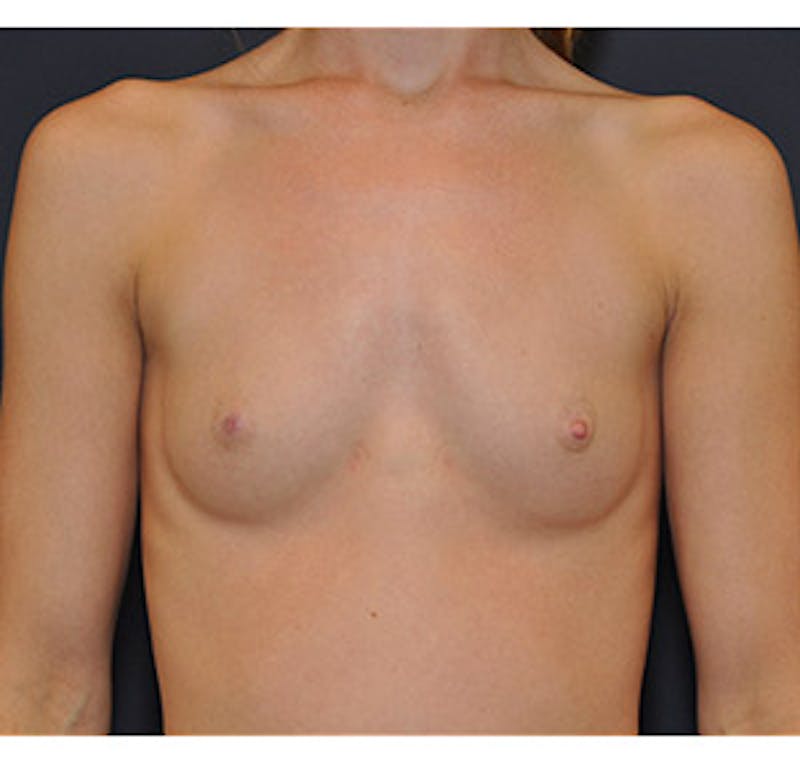Breast Augmentation Before & After Gallery - Patient 122054474 - Image 1