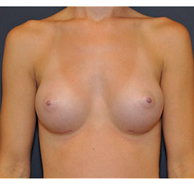 Breast Augmentation Before & After Gallery - Patient 122054474 - Image 2