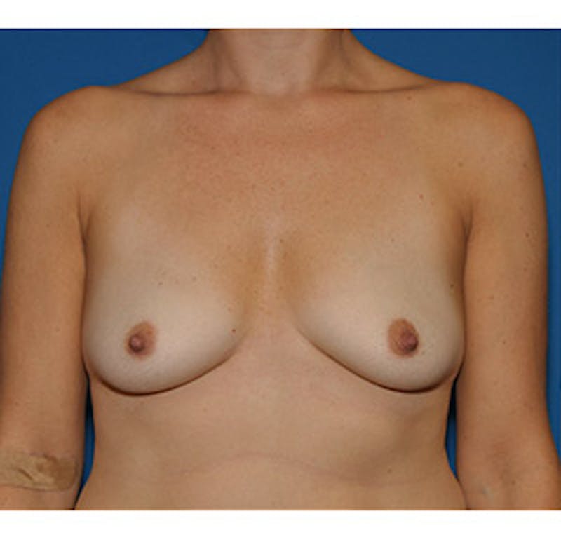 Breast Augmentation Before & After Gallery - Patient 122054475 - Image 1