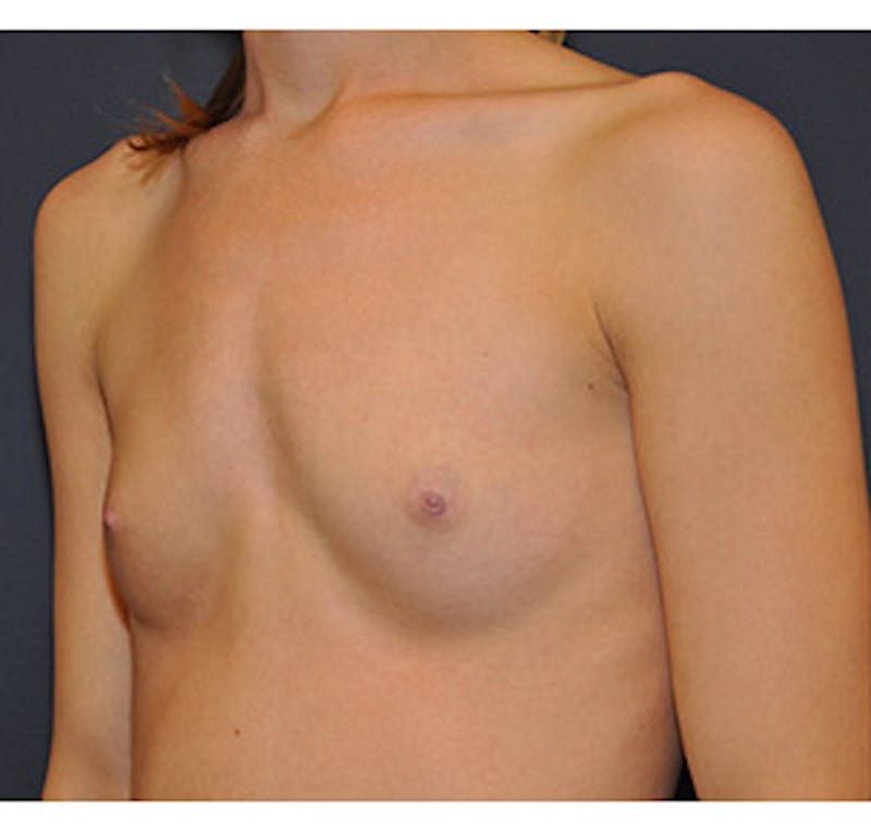 Breast Augmentation Before & After Gallery - Patient 122054474 - Image 3