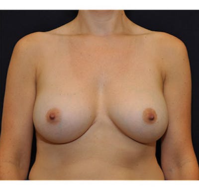 Breast Augmentation Before & After Gallery - Patient 122054475 - Image 2