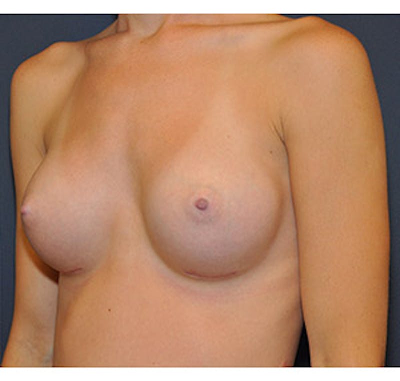 Breast Augmentation Before & After Gallery - Patient 122054474 - Image 4
